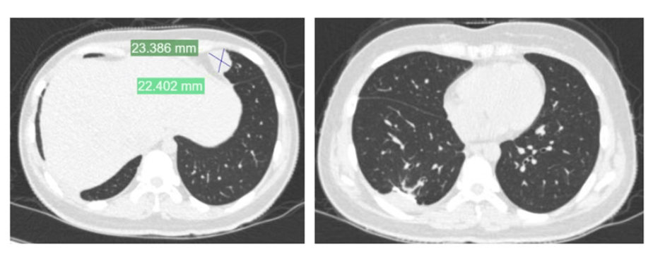 皇冠信用盘代理_女孩高考晕倒确诊骨癌！自己签字进行6次手术截肢皇冠信用盘代理，上海医生全力救治